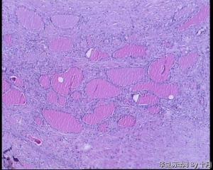 22岁，甲状腺囊性肿物，结甲囊性变？图1