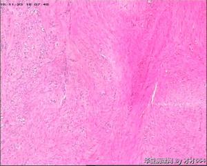 子宫肌瘤图2