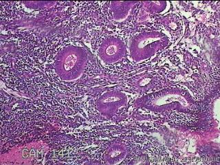宫腔内膜组织图47