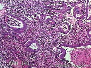 宫腔内膜组织图46