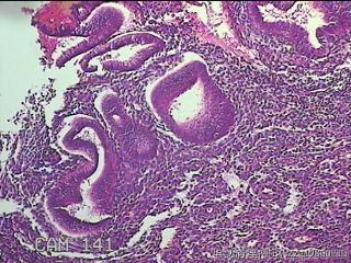 宫腔内膜组织图37