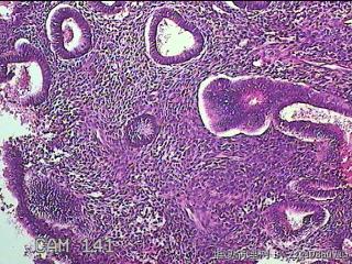宫腔内膜组织图44