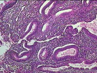 宫腔内膜组织图41