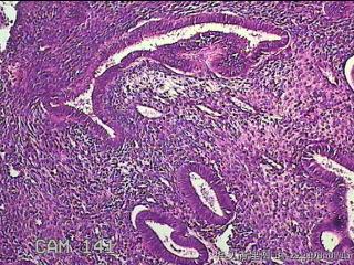宫腔内膜组织图50