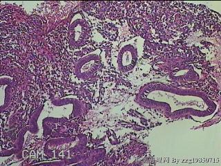 宫腔内膜组织图34