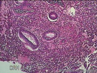 宫腔内膜组织图35