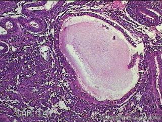 宫腔内膜组织图48
