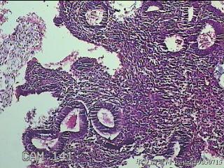 宫腔内膜组织图20