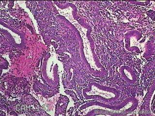 宫腔内膜组织图49