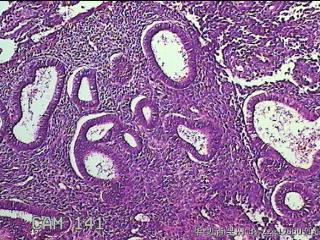 宫腔内膜组织图45