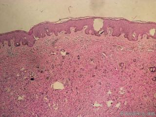 痣？恶黑？纤维组织细胞瘤？图2