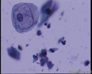 35岁，宫颈液基（上皮细胞量少）图6