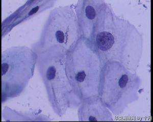 42岁，宫颈液基（曾做过宫颈锥切，日期不详）图5