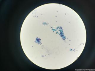 53岁，宫颈TCT图1