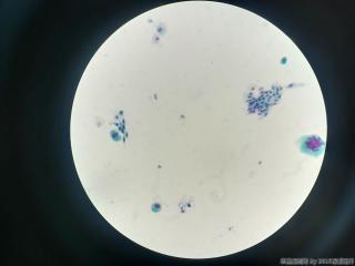 53岁，宫颈TCT图11