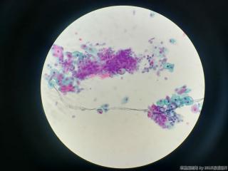 53岁，宫颈TCT图6