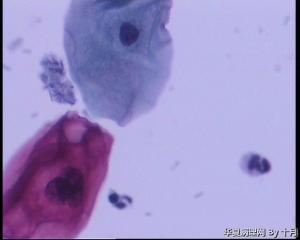 36岁本院职工，宫颈液基。图1