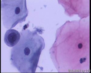 36岁本院职工，宫颈液基。图4