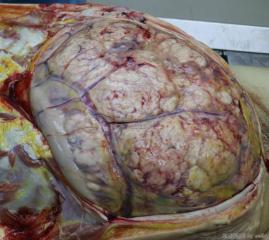 腹腔巨大肿瘤，是什么恶性肿瘤？图1