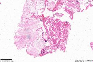 外耳道新生物，胆脂瘤图8