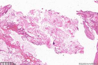 外耳道新生物，胆脂瘤图6