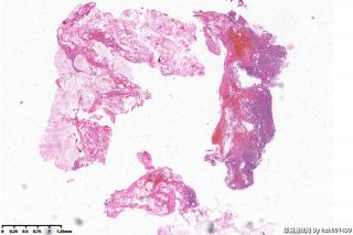 外耳道新生物，胆脂瘤图1
