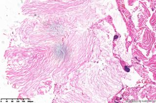 外耳道新生物，胆脂瘤图9