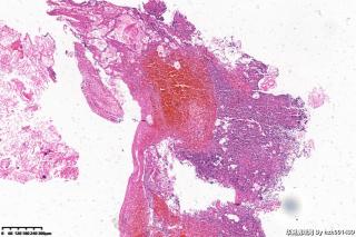 外耳道新生物，胆脂瘤图3