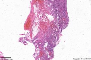 外耳道新生物，胆脂瘤图2