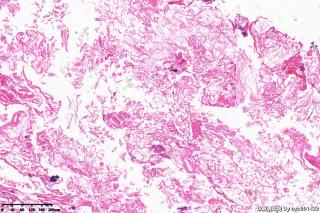 外耳道新生物，胆脂瘤图7