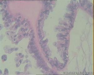 双侧卵巢肿物图14