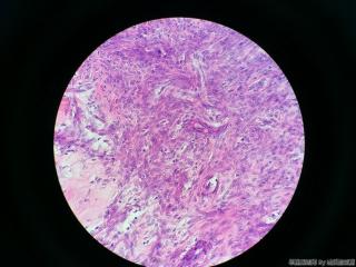 子宫肌瘤图9
