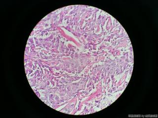 子宫肌瘤图12