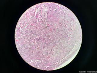 子宫肌瘤图11