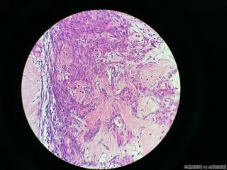 子宫肌瘤图6