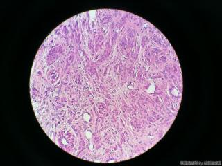 子宫肌瘤图4
