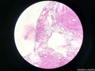 子宫肌瘤图5