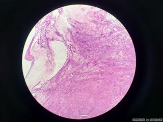 子宫肌瘤图8