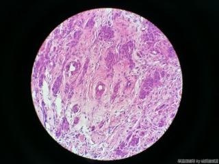 子宫肌瘤图2