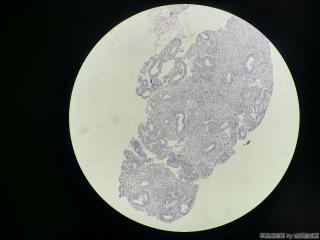 诊刮，内膜单纯增生？还是息肉？图13