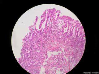 胃窦活检组织图4