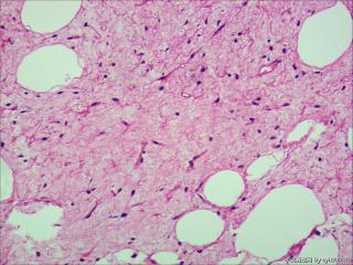 高分化脂肪肉瘤or去分化脂肪肉瘤？图6