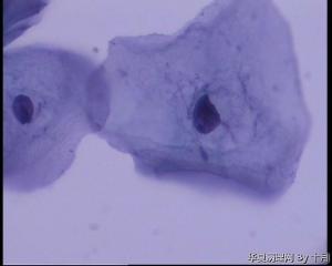 47岁，宫颈液基（如果HPV58阳性，该怎么报合适？）图4