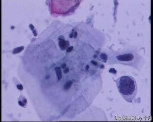 45岁，宫颈液基，后续会上传组织图片。图10