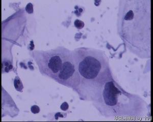 45岁，宫颈液基，后续会上传组织图片。图40