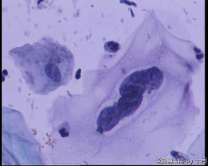 45岁，宫颈液基，后续会上传组织图片。图7