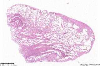 肺大疱组织，取材时未见到肺大疱图1