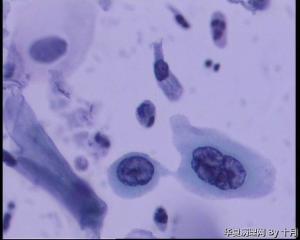 45岁，宫颈液基，后续会上传组织图片。图35