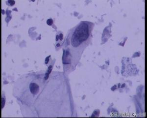 45岁，宫颈液基，后续会上传组织图片。图27