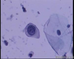 45岁，宫颈液基，后续会上传组织图片。图19